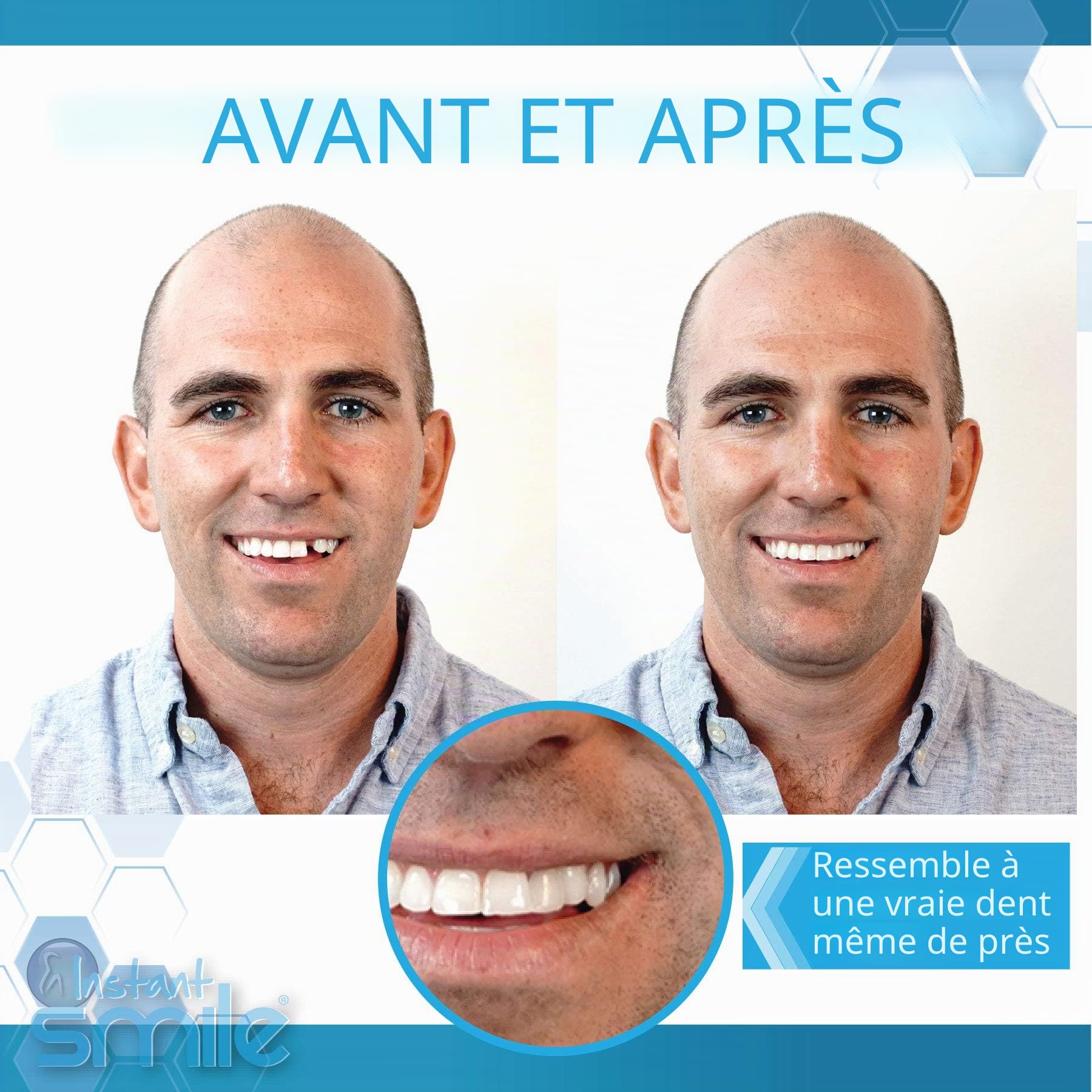 Instant Smile Complétez Votre Sourire Temporary Dental Replacement Kit – Kit Dentaire de Remplacement, Facile à Utiliser, Sourire Instantané, Taille Unique