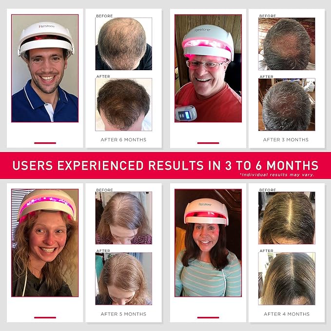 iRestore Laser Hair Growth System 