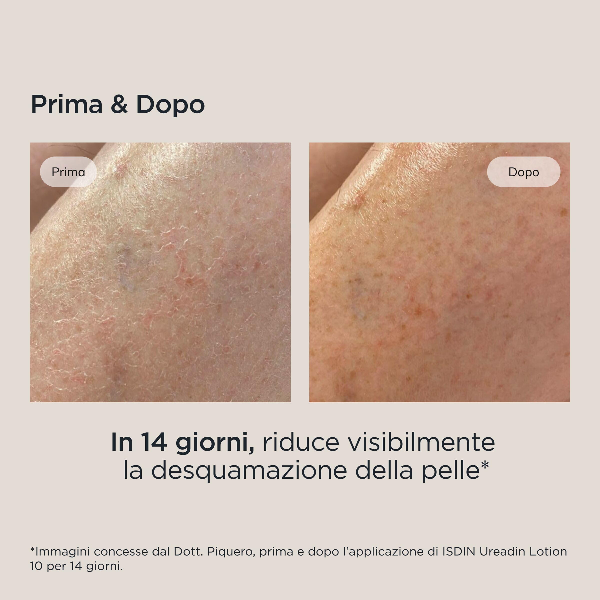ISDIN Ureadin Lotion10 (400 ml) | Lozione Idratante con 10% Urea | Idrata Intensamente e Aiuta ad Alleviare la Sensazione di Tensione | Consigliata per Pelli Secche