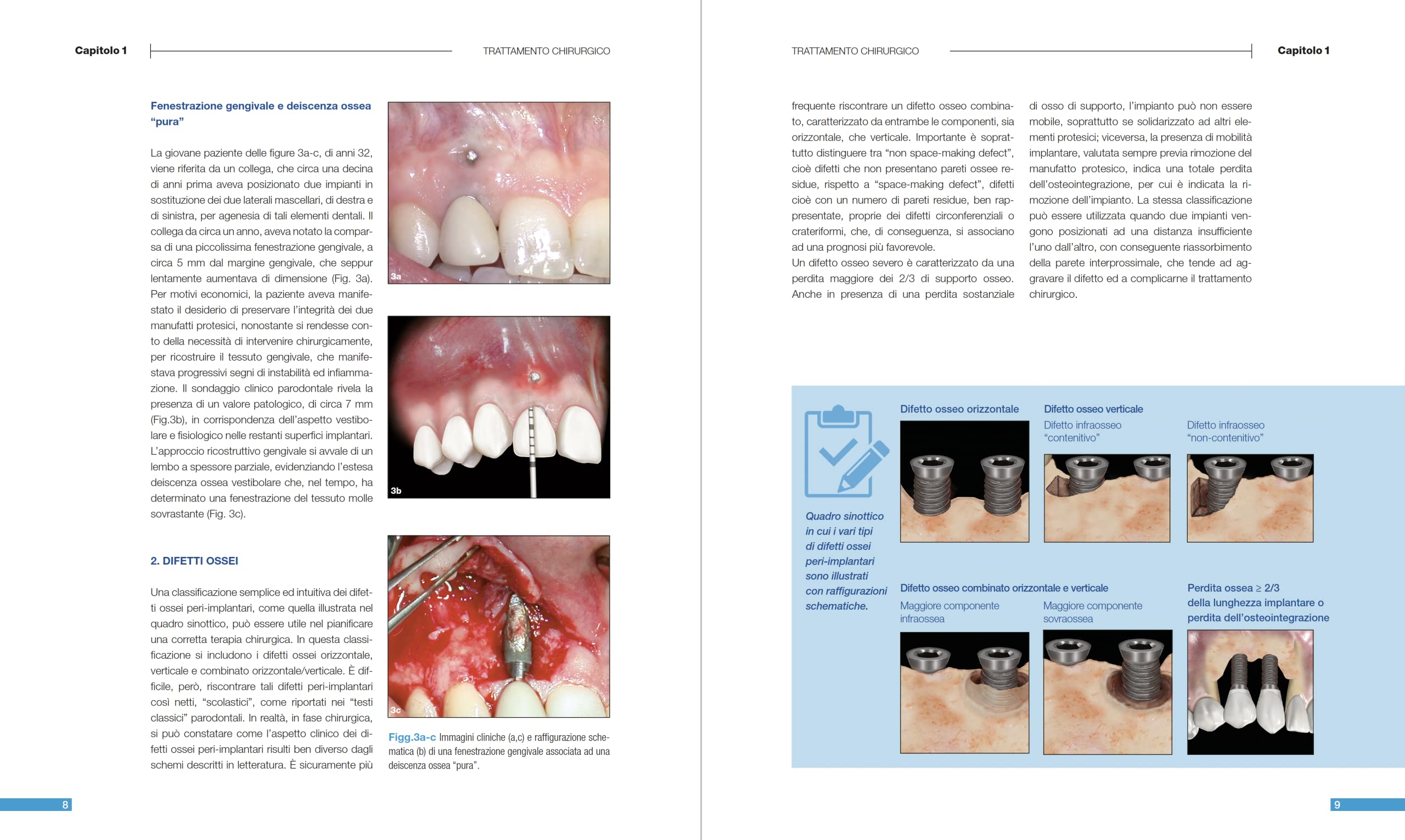 Malattie peri-implantari. Trattamenti chirurgici