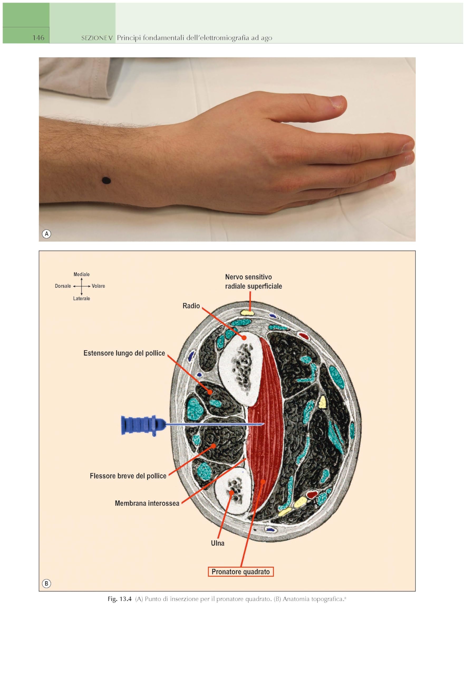 Elettromiografia e disordini neuromuscolari. Correlazioni clinico-elettrofisiologiche ed ecografiche