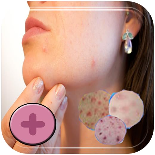 Treatment for Chickenpox