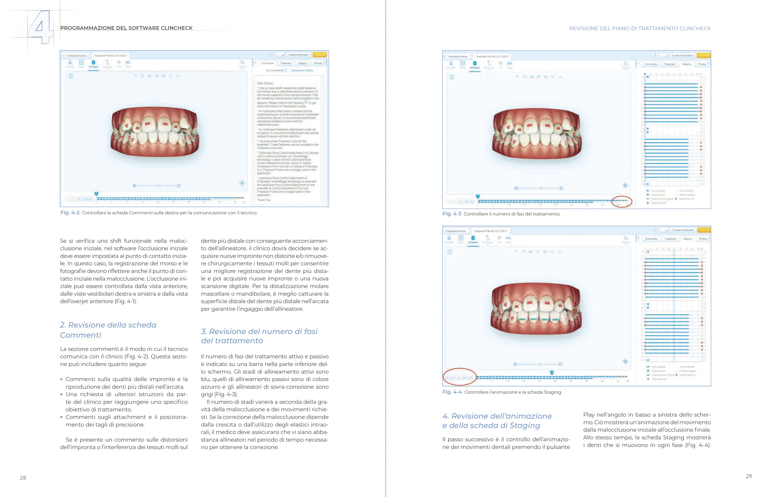 Allineatori trasparenti. Biomeccanica e gestione clinica