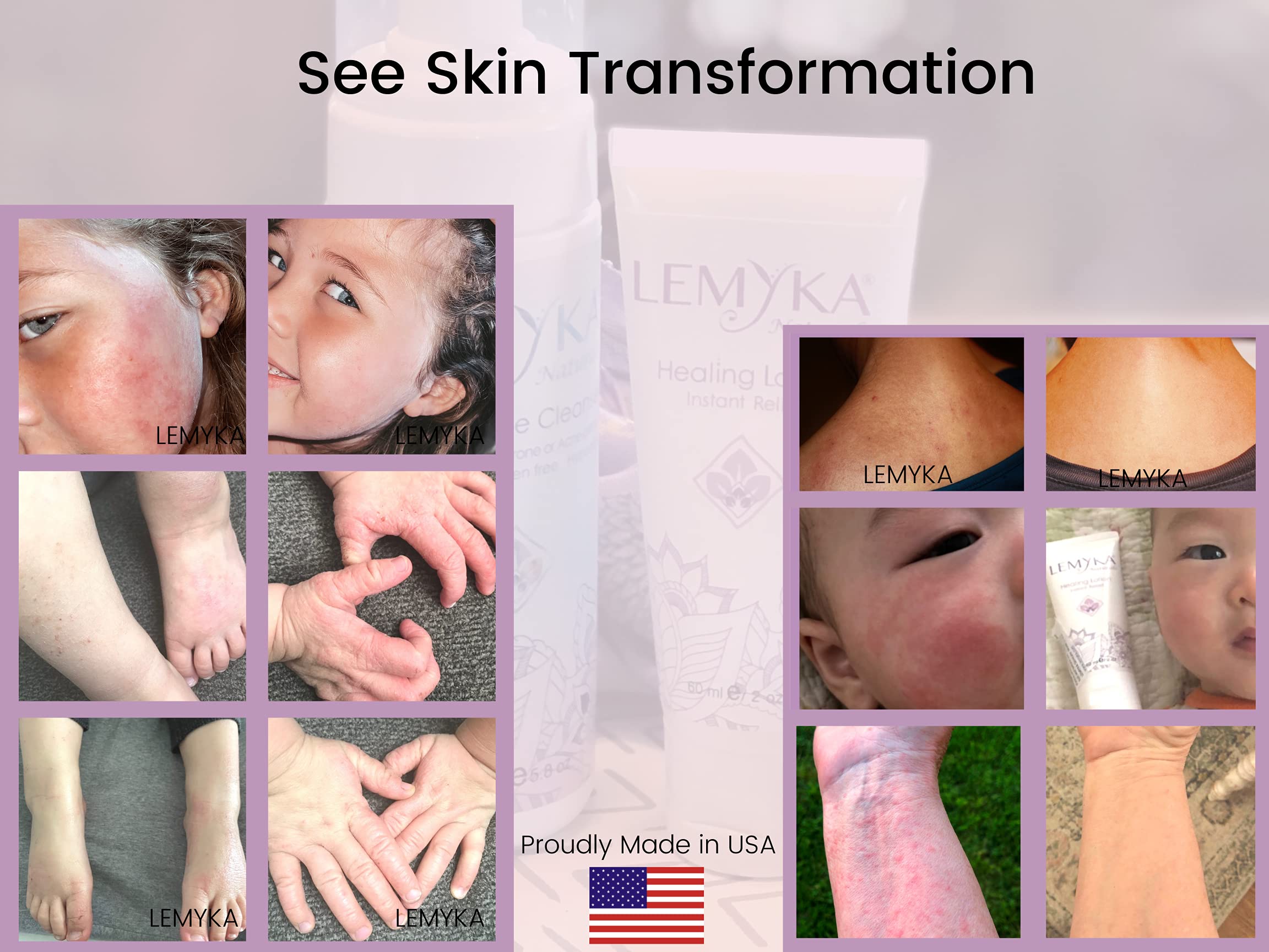 Buy LEMYKA Eczema Lotion for dry itchy skin Rosacea treatment Face