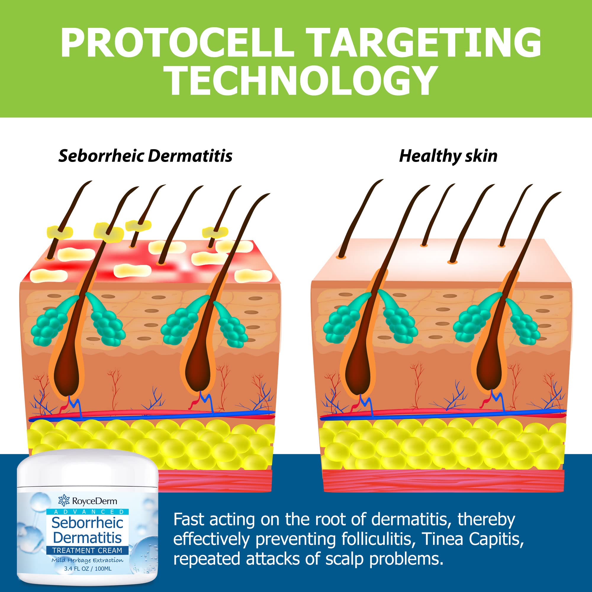 Buy Seborrheic Dermatitis Cream, Scalp Treatment For Psoriasis
