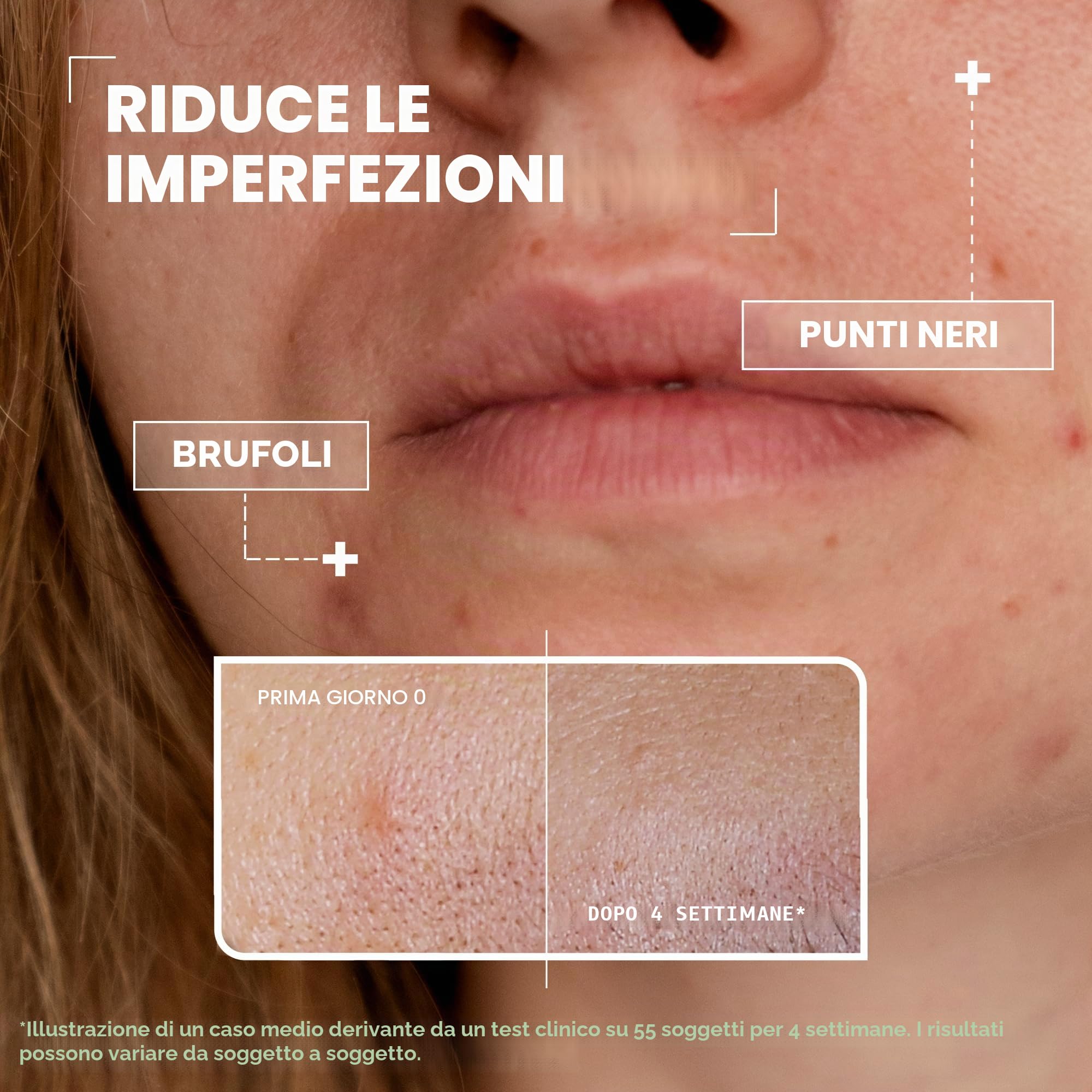 Mixa - Siero concentrato anti-imperfezioni - Per pelli con imperfezioni - Arricchito con acido salicilico e niacinamide - 30 ml | Riduce brufoli e punti neri, restringe i pori, ipoallergenici pelli sensibili, testato sotto controllo medico
