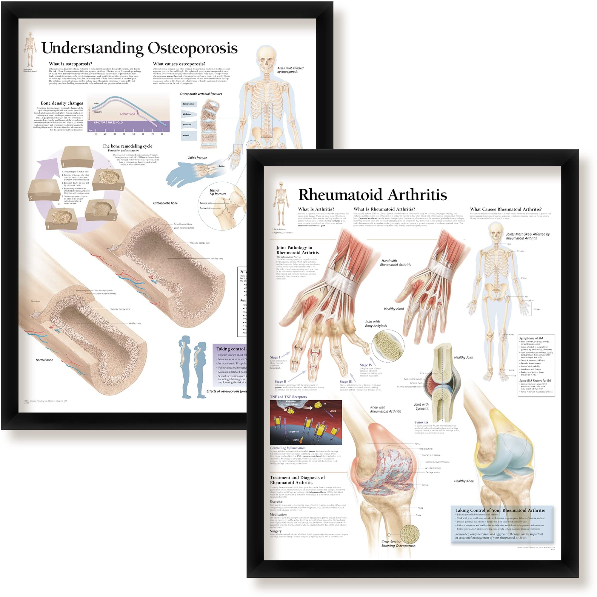 Set of 2 Framed Medical Posters Understanding Osteoporosis and Rheumatoid Arthritis 22