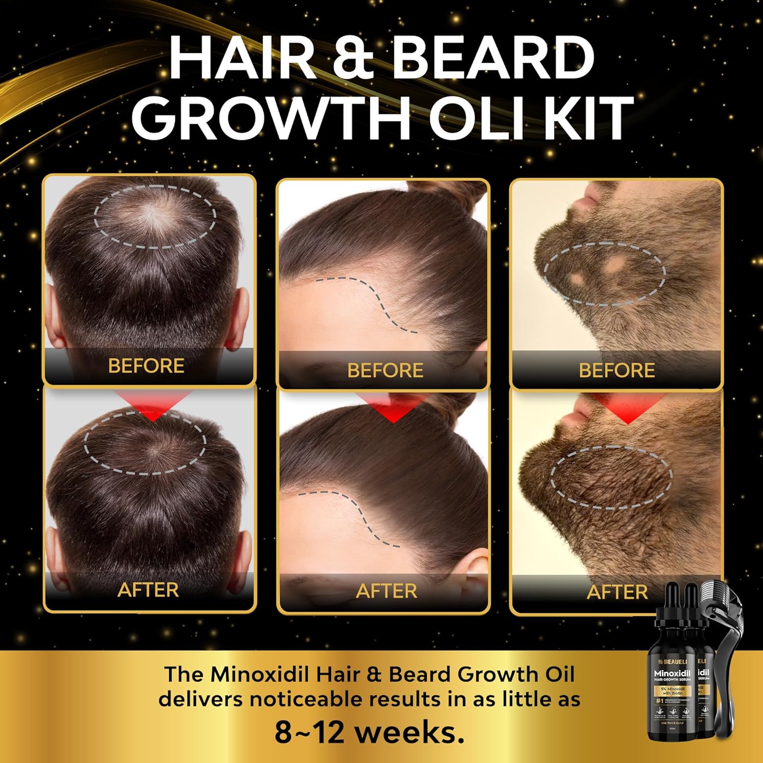 Minoxidil Beard Growth Kit For Men and Women, Hair Loss and Hair Regrowth Treatments, Minoxidil 5%, Black 60ml 2 Bottles - Image 2