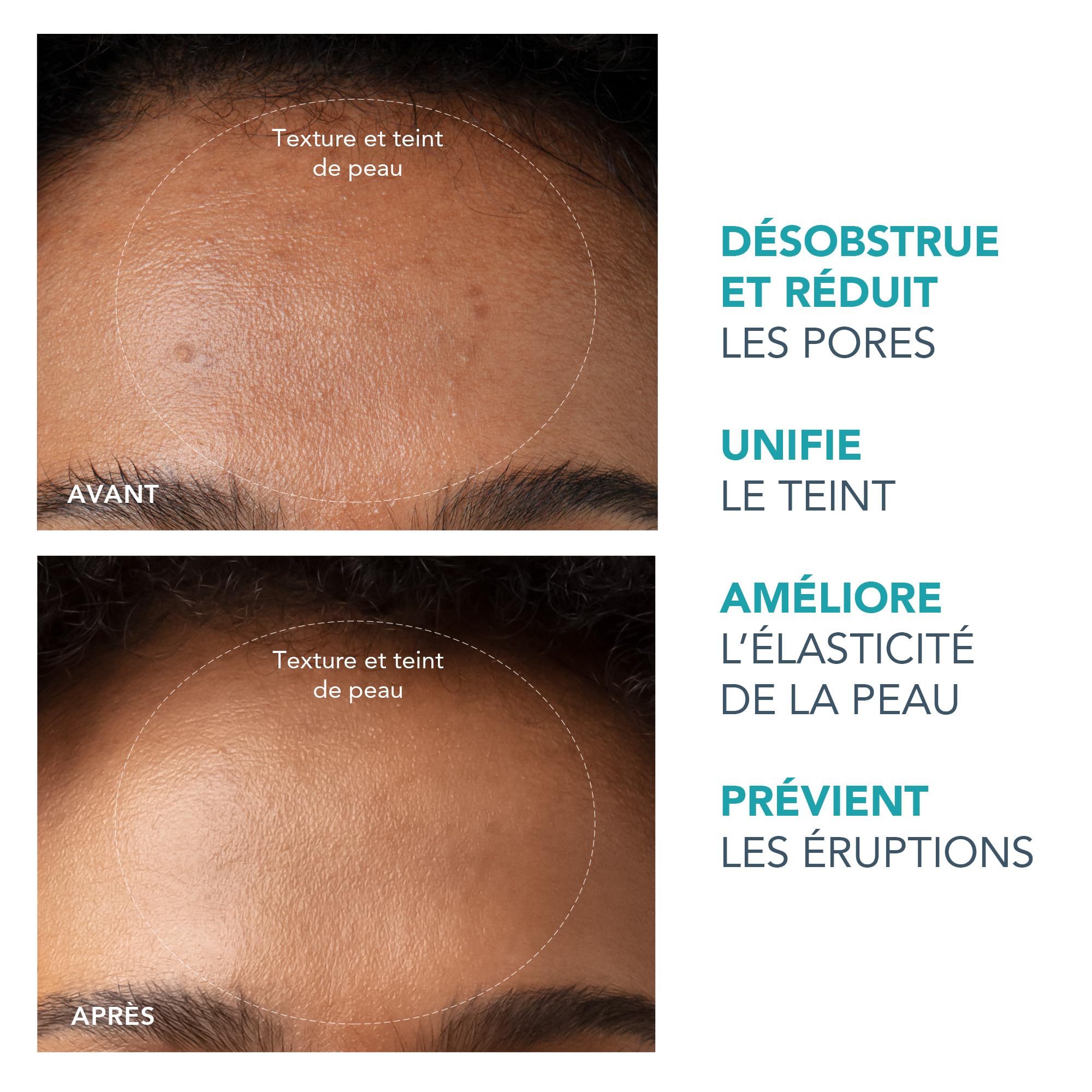 FOREO KIWI Elimina puntos negros + Mascarilla Active Pore 100 g Set | elimina puntos negros, aspirador de poros, extractor, minimiza poros, mascarilla facial, limpiador de poros, comedones