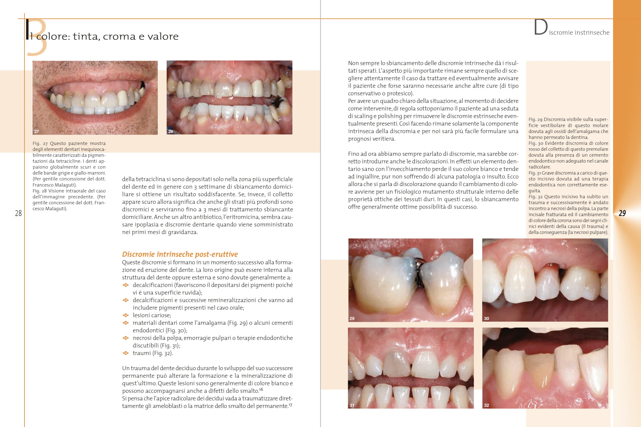 Sbiancamento dentale