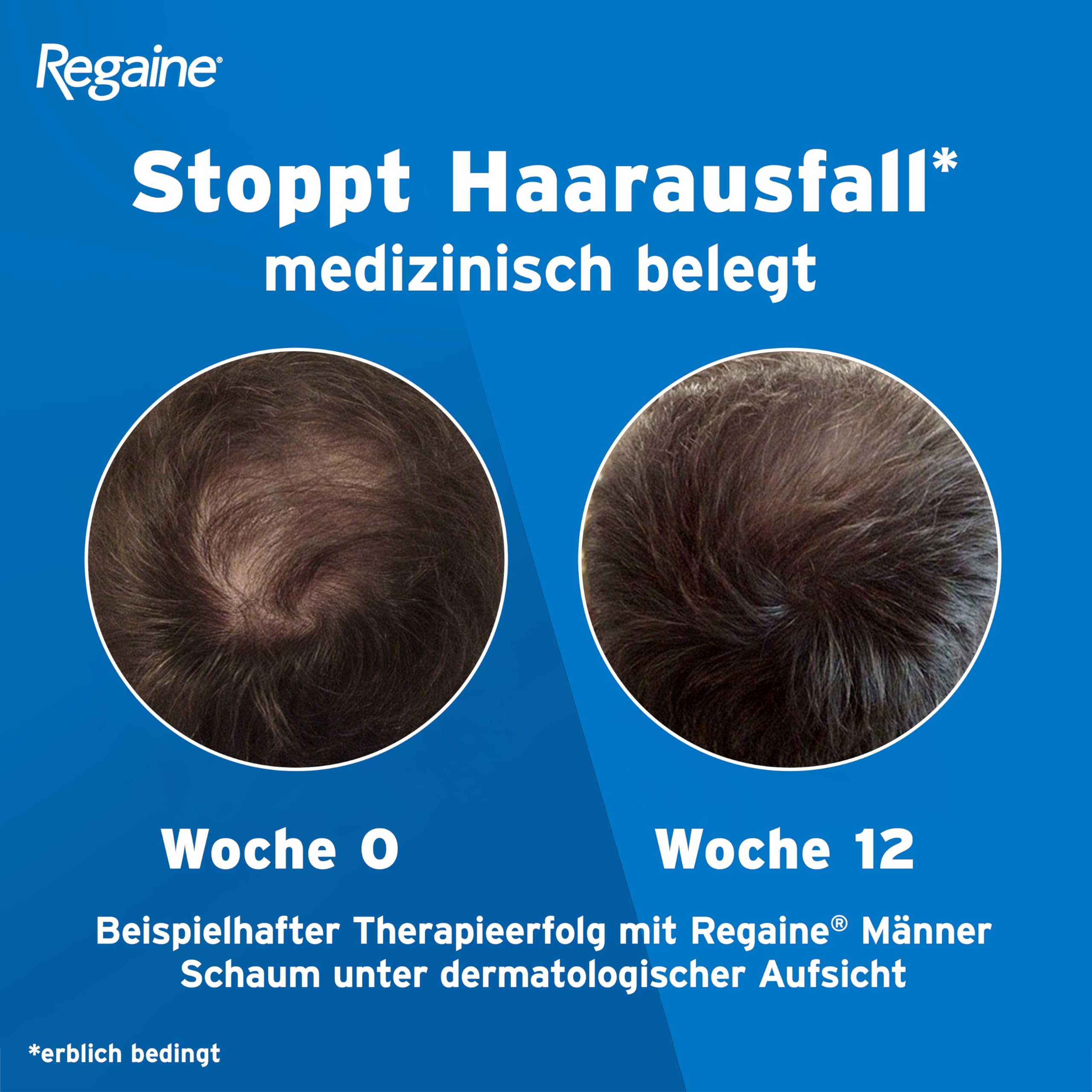 REGAINE Männer Lösung: Mit 50 mg/ml Minoxidil (5%) bei erblich bedingtem Haarausfall, 6-Monats-Vorrat, 6 x 60 ml