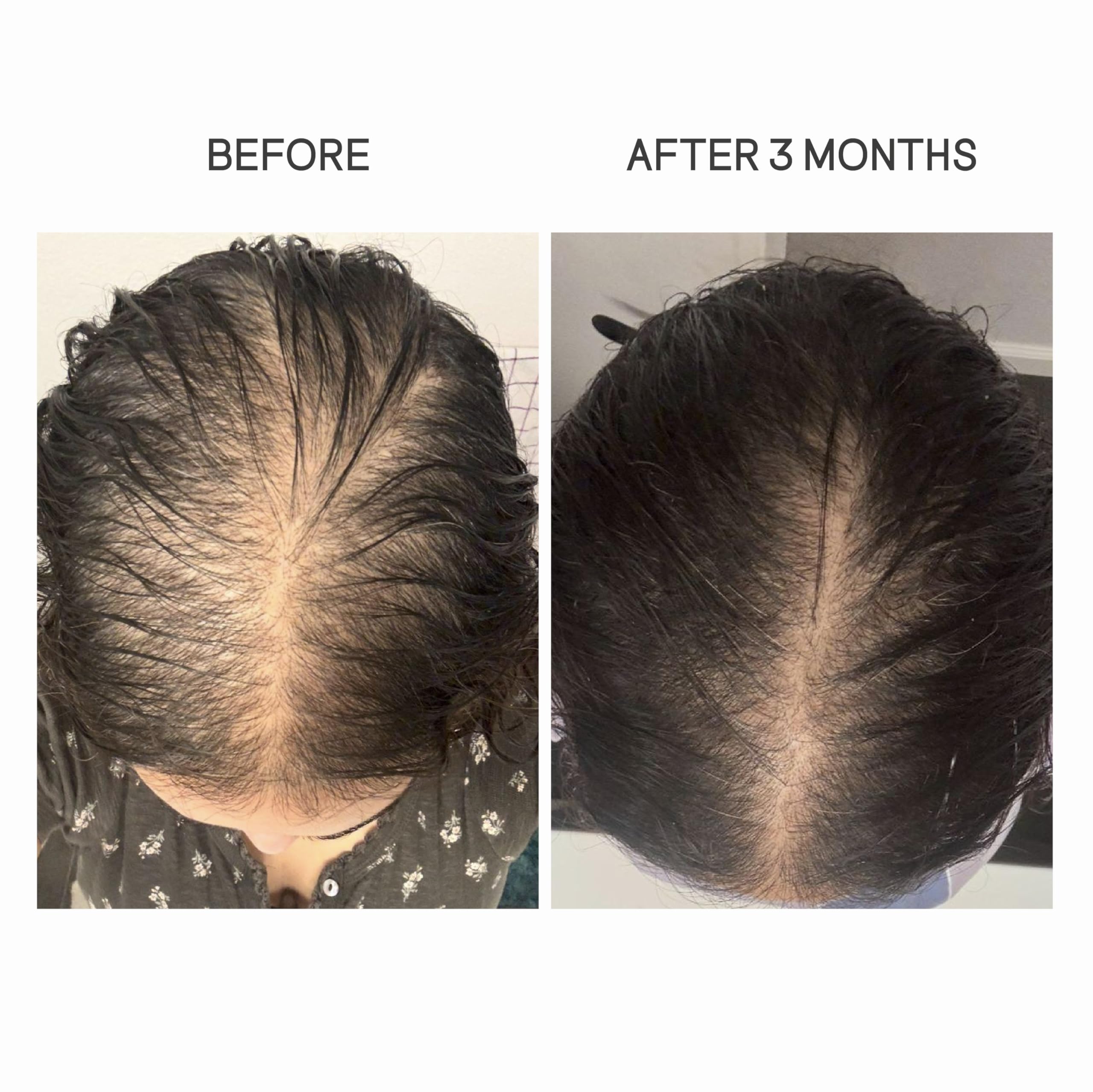 Tratamiento de pérdida de cabello posparto para mamás, aceite bloqueador de crecimiento del cabello DHT con romero, semillas de calabaza y aceite de semillas negras, natural y seguro para adelgazar el 4