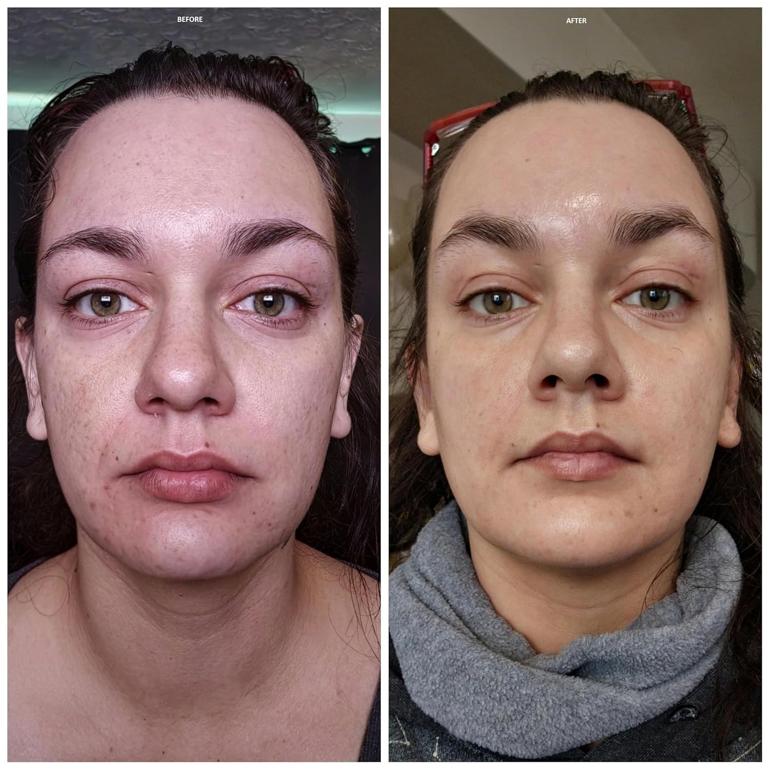 Salicylic Acid Solution Acid Peel 40% 1oz. 30ml (Level 2 pH 1.9) - Exfoliating (FREE Neutralizer 100ml)