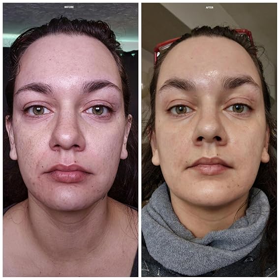 Salicylic Acid Solution Acid Peel 20% 1oz. 30ml (Level 2 pH 1.9) - Exfoliating (FREE Neutralizer 100ml)
