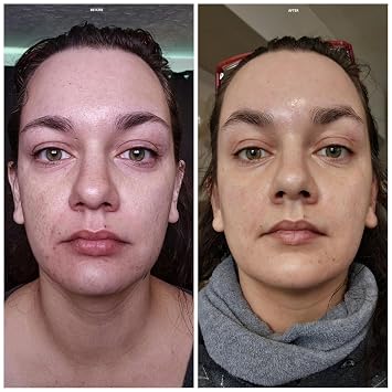 Salicylic Acid Solution Acid Peel 20% 1oz. 30ml (Level 2 pH 1.9) - Exfoliating (FREE Neutralizer 100ml)