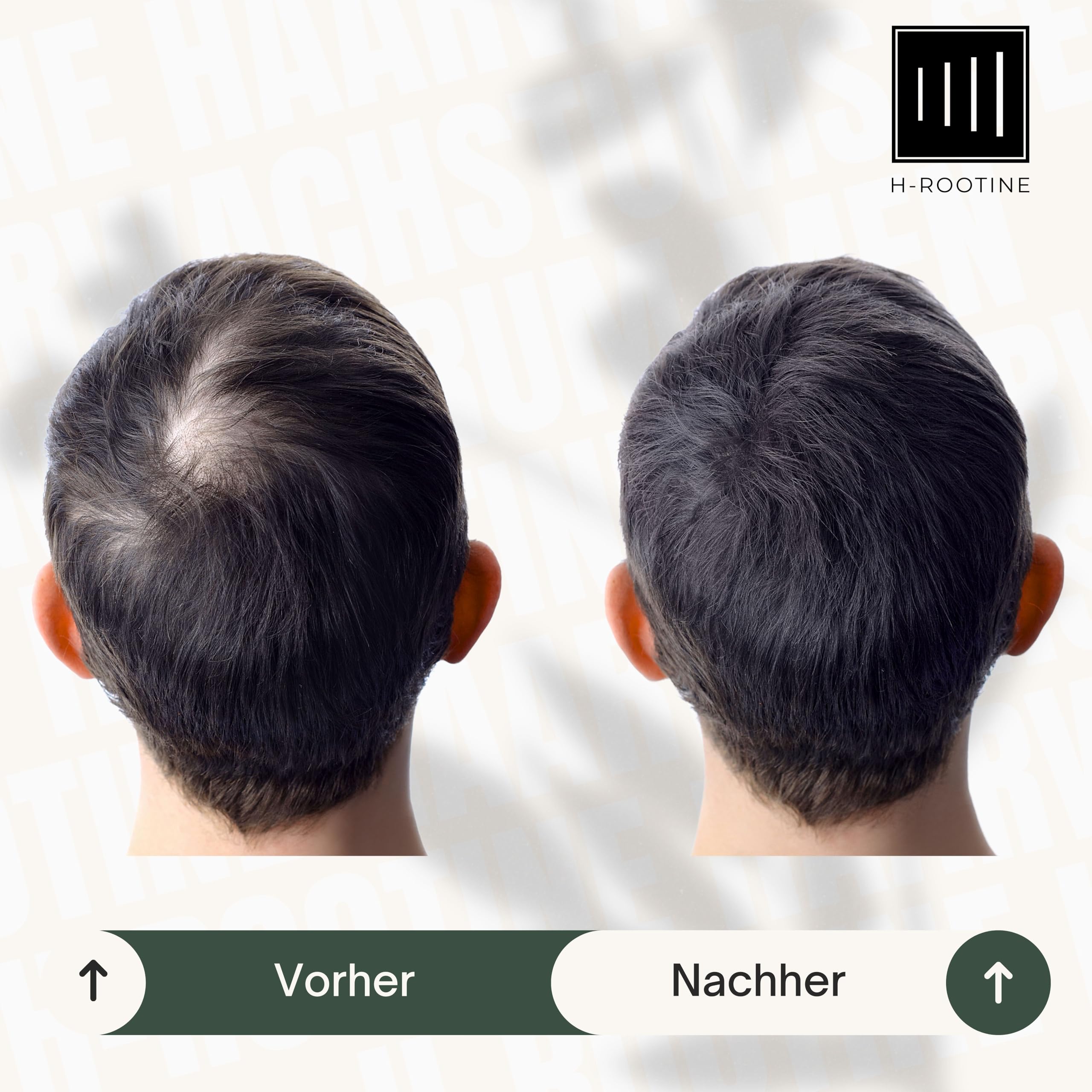 Haarserum für Männer (100ml) • Haarwuchsmittel Männer • Stoppt erblich & hormonell bedingten Haarausfall* • Fördert Haarwachstum (Haarserum MEN 100ml (2er-Set))