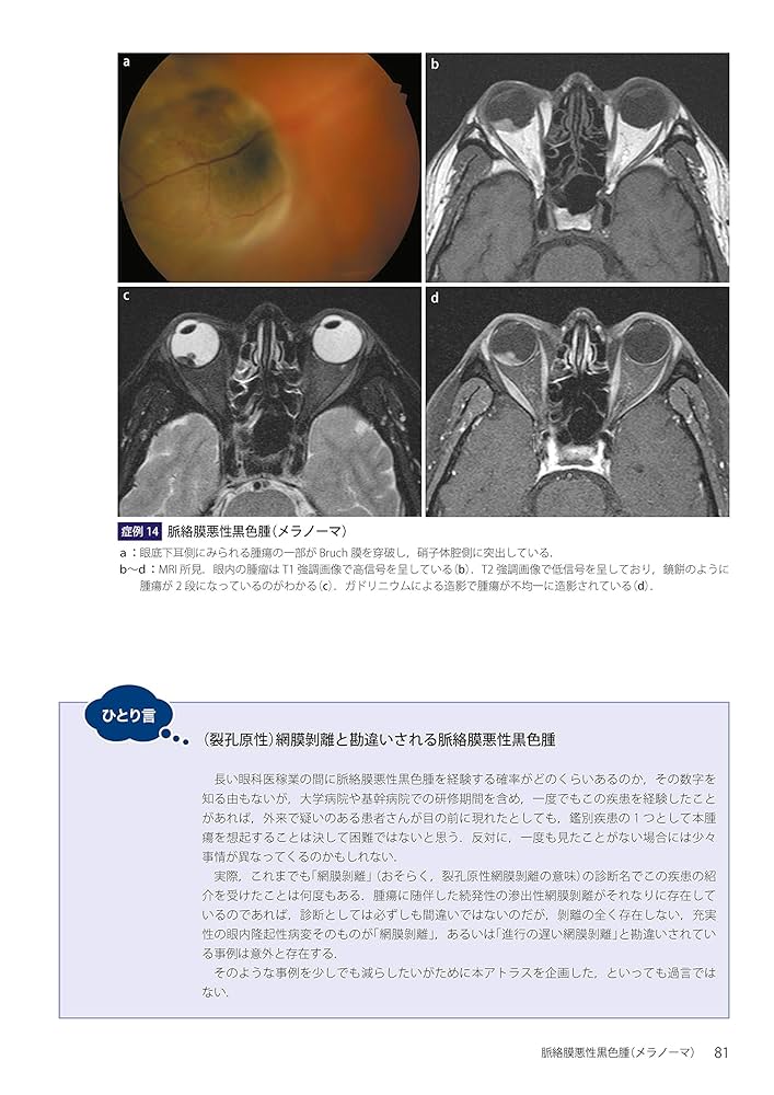 眼腫瘍アトラス (最新医学シリーズ) 眼瞼・結膜腫瘍アトラス | 書籍詳細 | 書籍 | 医学書院