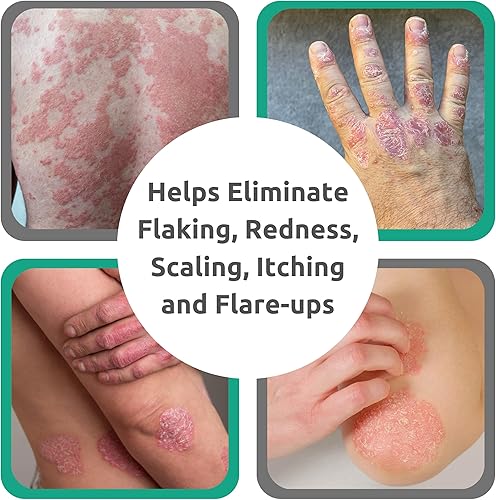 Miniatura 6 de Dr Blaines REVITADERM - Fórmula de psoriasis - Crema tópica calmante con alquitrán de carbón aceite de árbol de té y aceite de lavanda para picazón