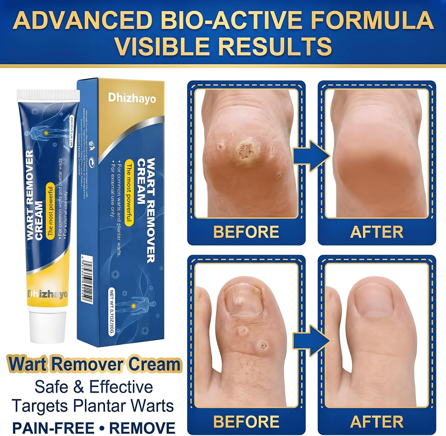 wart Remover Freeze Off,with Salicylic Acid 17% - Fast-Acting Gel for Common & Plantar Warts on Hands and Feet, Maximum Strength - 20G/0.7OZ