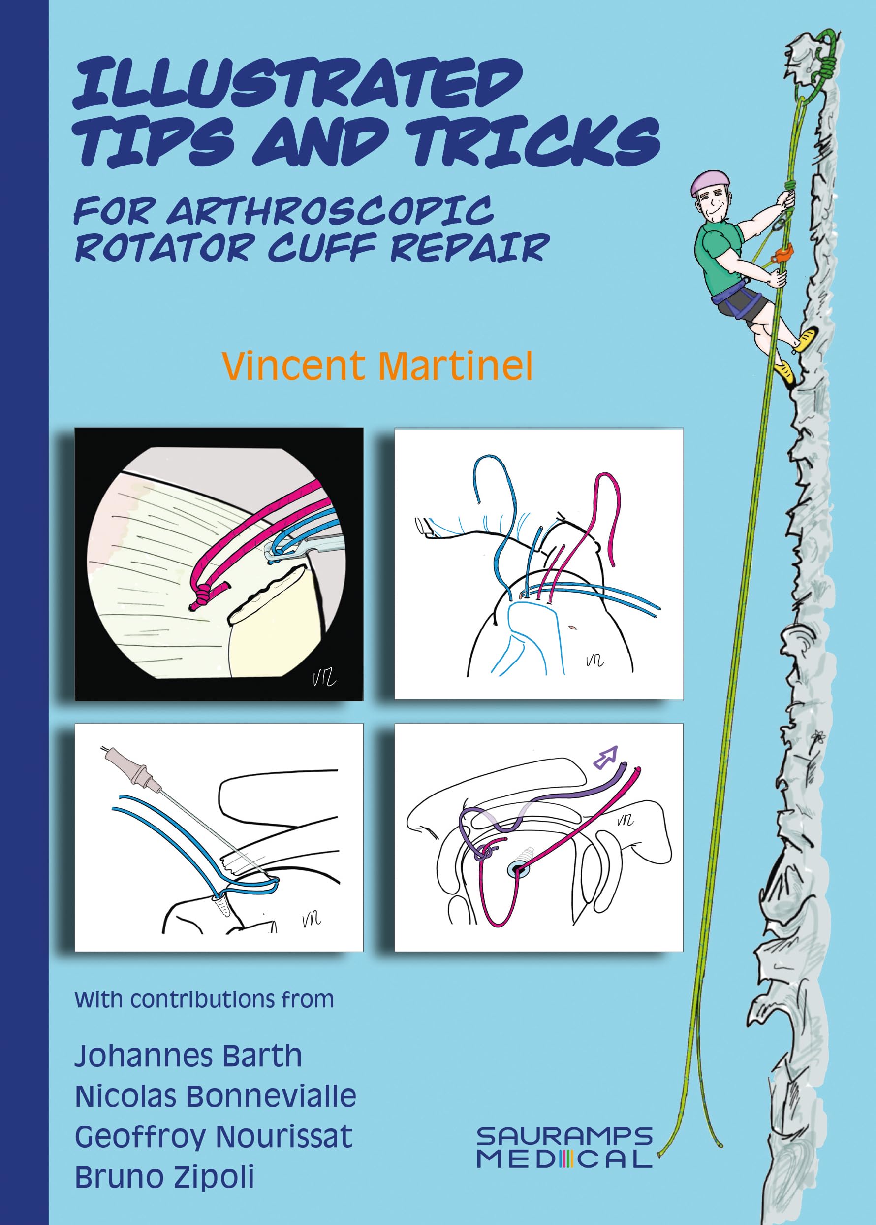 Illustrated tips & tricks for arthroscopic rotator cuff repair