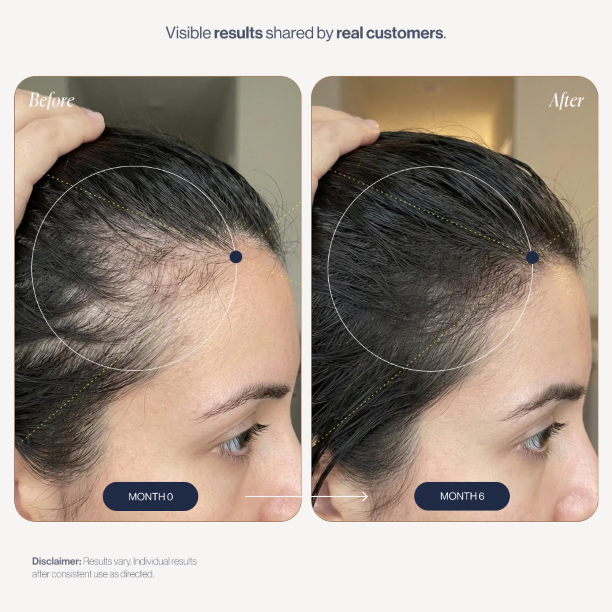 Growplex Vitafoam 5% Minoxidil Foam for Men & Women