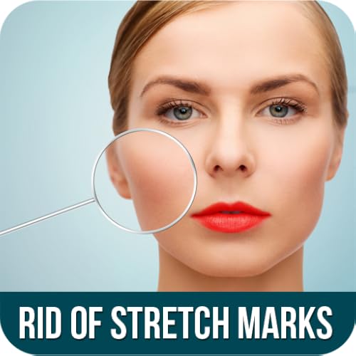 How to Get Rid of Stretch Marks