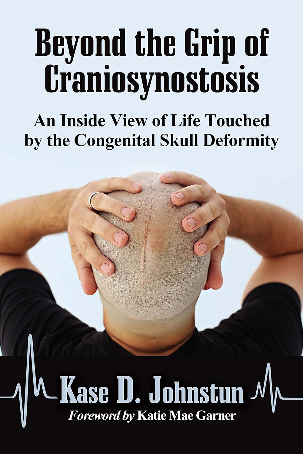 Beyond the Grip of Craniosynostosis: An Inside View of Life Touched by the Congenital Skull Deformity