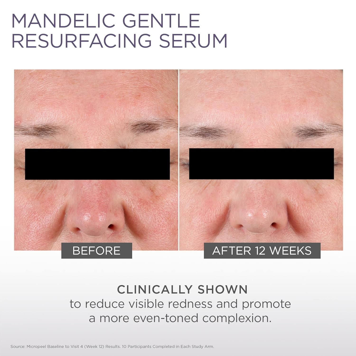 Glytone Micro-Peel 10% Mandelic Acid Serum | Anti-Aging AHA Gentle Exfoliant with Phytic Acid for all Skin types | Reduces Redness, Uneven tone & Dark Spots | Fragrance-Free, Paraben-Free - 1 Fl oz. - Image 5