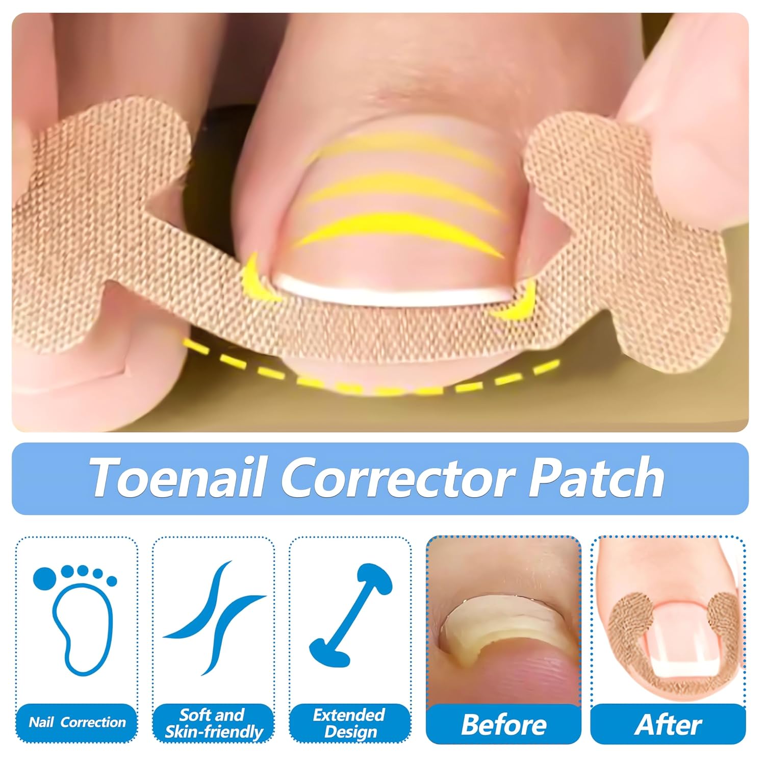 Ingrown Toenail Corrector Set with Correction Strips, Professional Ingrown Toenail Removal Kit, Painless File and Lifter Pedicure Tool Curved Toenails Corrector Patch for men and women