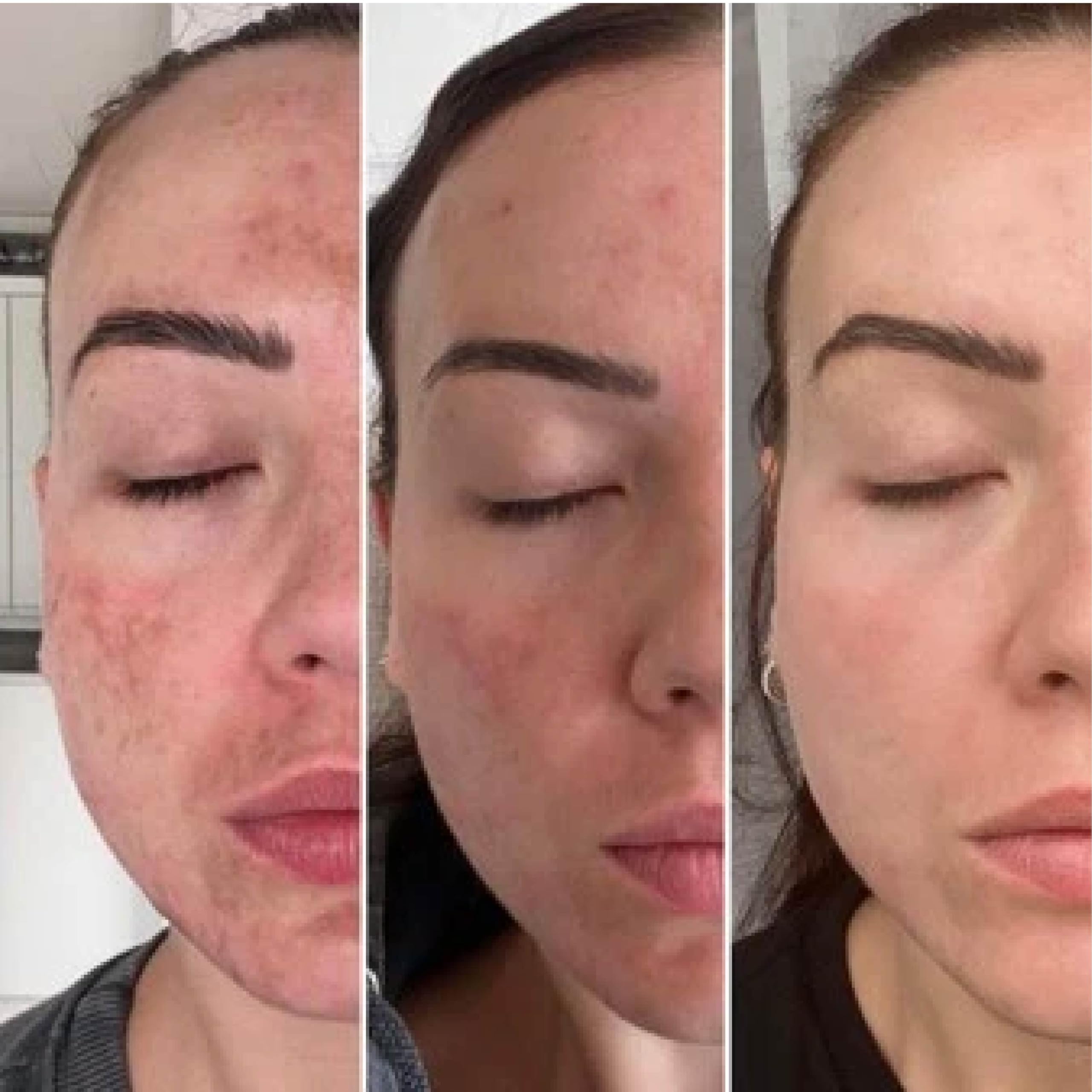 TCATherapyCare Solution Acid Peel 60% (Livello 2 pH 1.9) - Esfoliante, texture e tono della pelle - peeling viso - 30 ml con neutralizzatore (100 ml)