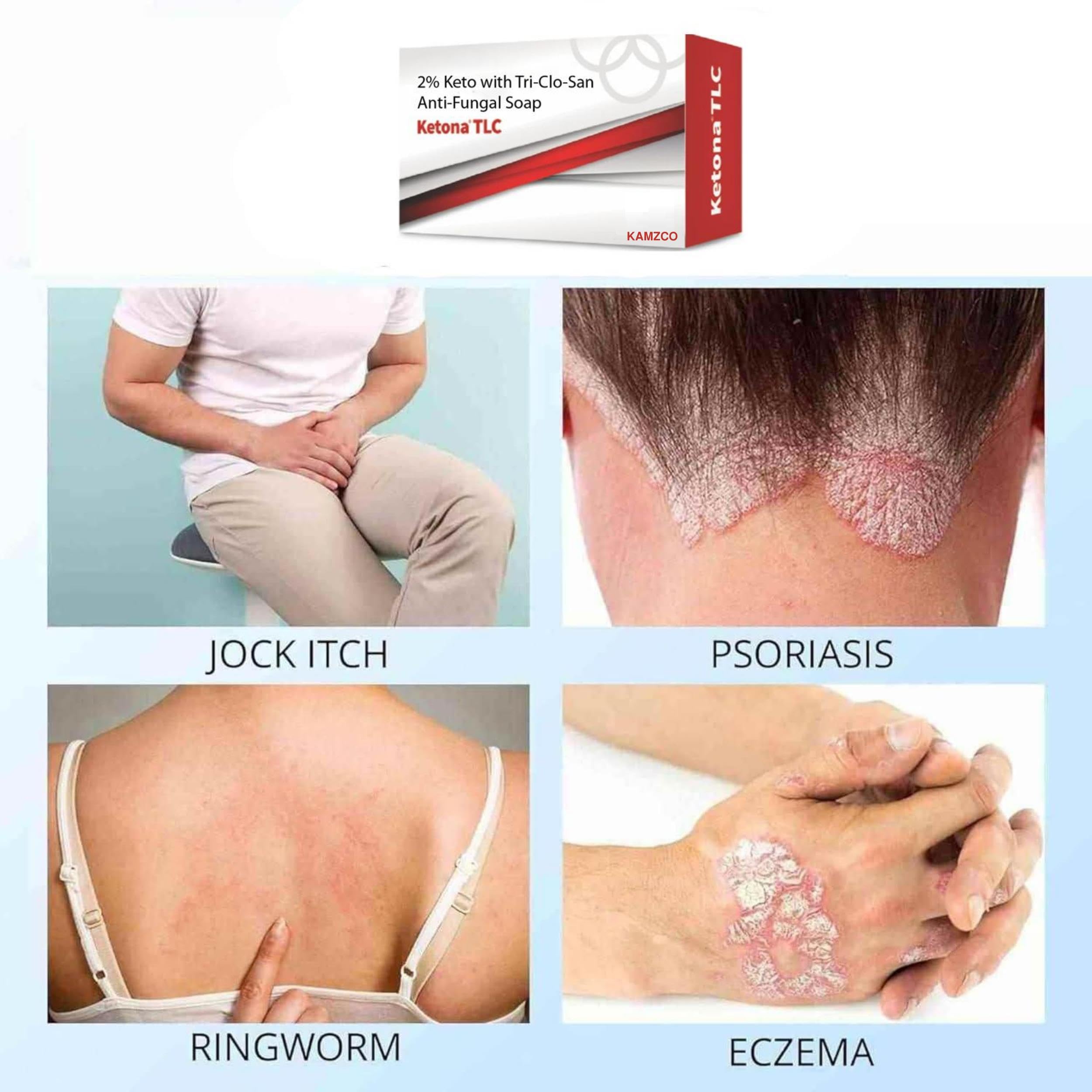 Skin Bar Antifungal Soap - Fights Ringworm, Jock Itch, Dandruff, Body Acne & Dry Skin, 100 g (Pack of 1) - Image 2