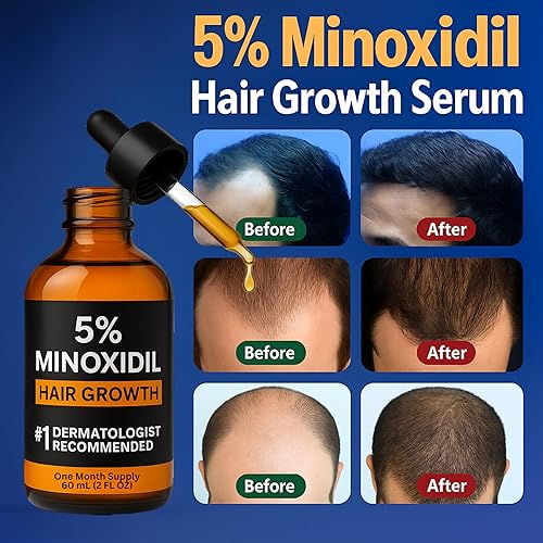 Miniatura 3 de Minoxidil para hombres 5% Tratamiento de crecimiento del cabello extra fuerte  Solución para crecimiento de barba, cuero cabelludo y pérdida de