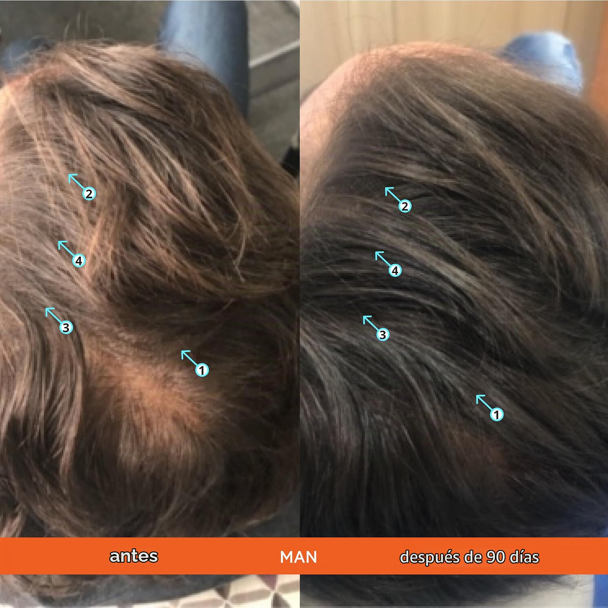Revita Champú y acondicionador para adelgazamiento del cabello de DS Laboratories - Apoya el crecimiento del cabello para hombres y mujeres, espesa el cabello, sin sulfato, bloqueador de DHT (925 ml)