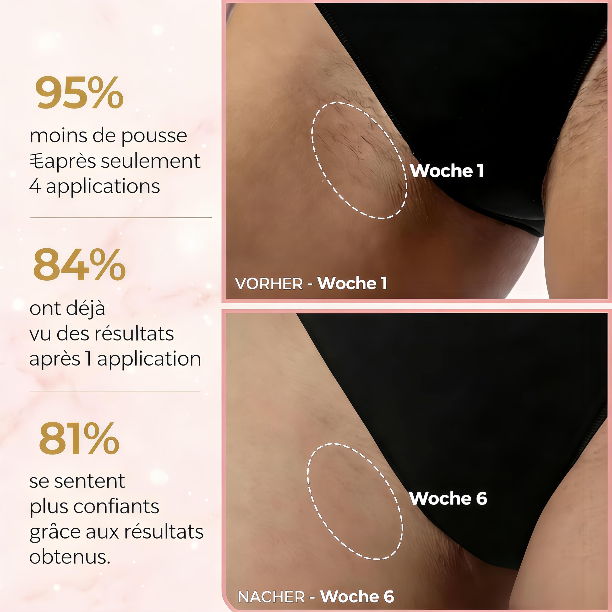 Solippy Loop Epilateur Laser,2026 Loop De Solippy Epilateur Ipl,Épilation Laser Indolore,Pour Épilation Définie Du Visage, Corps, Bikini Et Aisselles (Blanc)