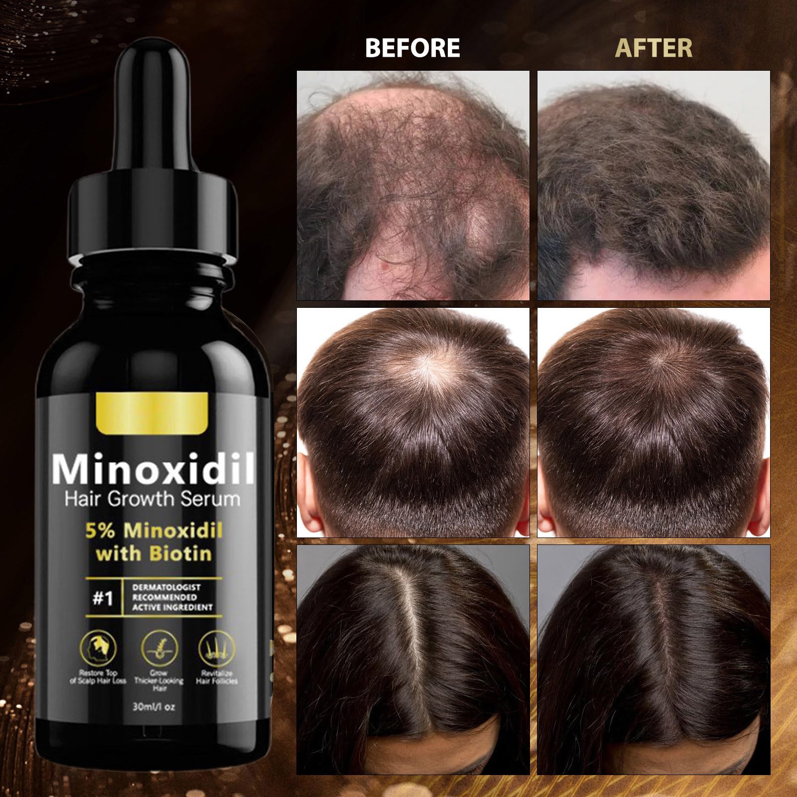 Minoxidil Hair Serum, Suitable for Both Men and Women, 5% Minoxidil Hair Growth, Resulting In Thicker, Stronger Hair. - 5