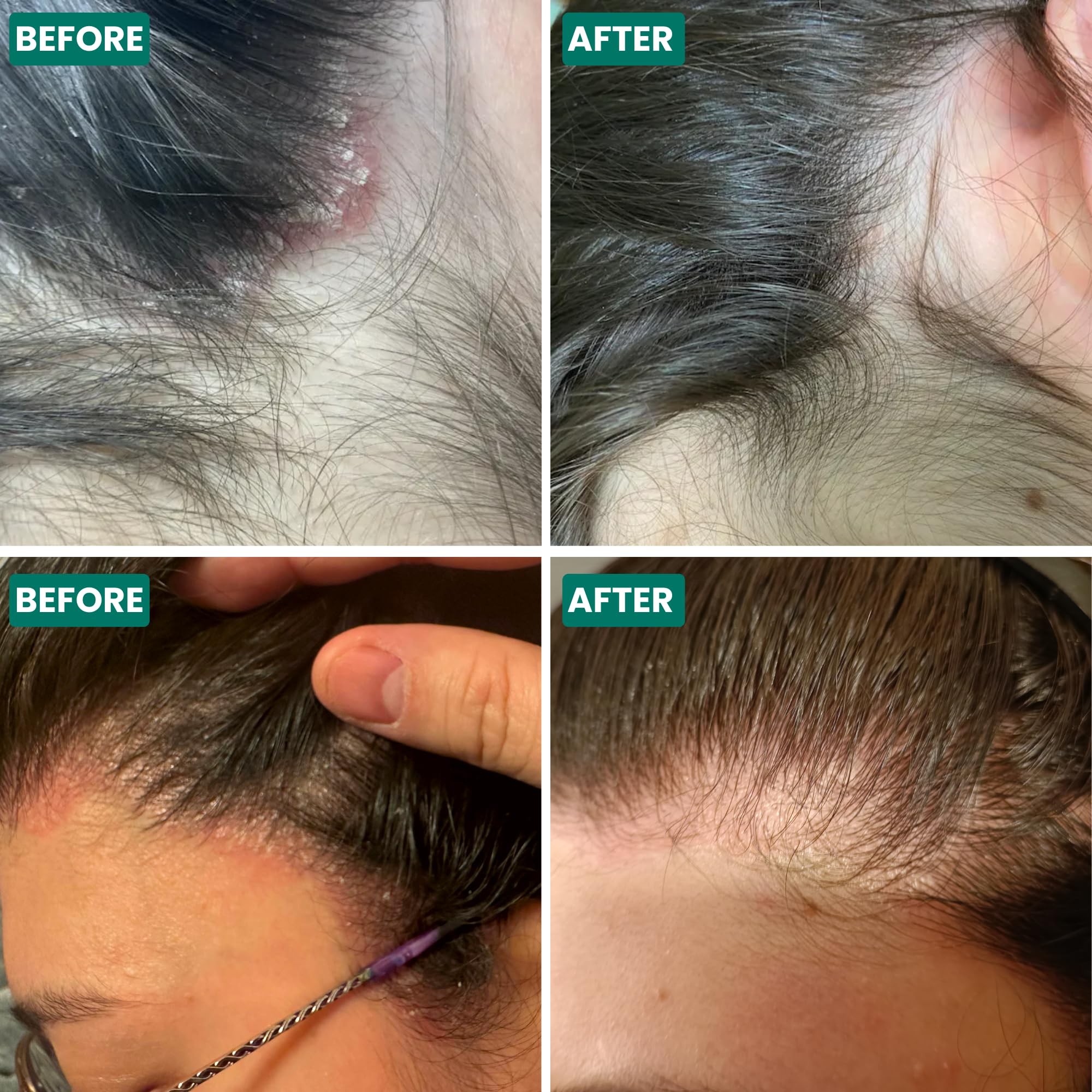 Grahams Natural Scalp Relief Oil, for Dry Itchy & Flaky Scalp Psoriasis, Seborrheic Dermatitis & Dandruff Treatment - Image 4