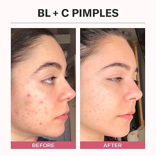 Miniatura 5 de Odacité - Suero facial y máscara para el acné aceite facial limpiador de poros para el cuidado de la piel BlC receta de brillo de comino negro y