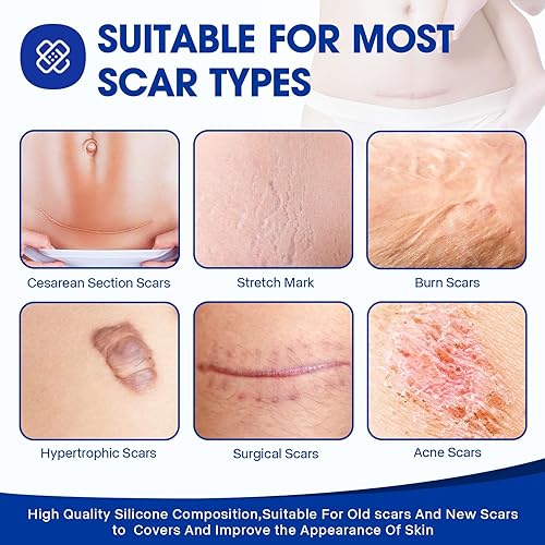 Miniatura 3 de Hojas de silicona para cicatrices, cinta de silicona de grado médico (rollo de 1.6 x 60 pulgadas - 4.9 ft), cinta para cicatrices quirúrgicas,