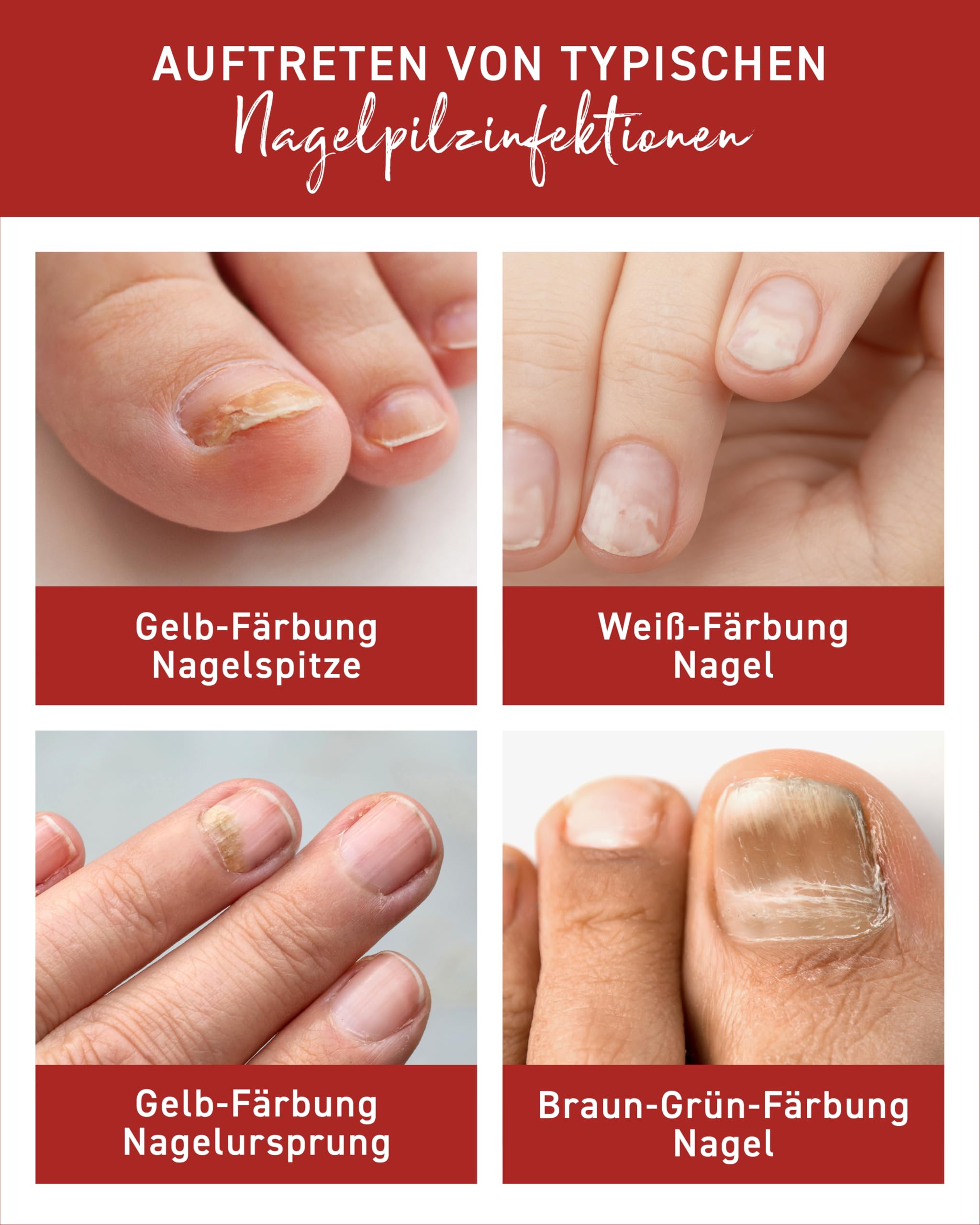 N1 Solución para hongos en las uñas, 20 ml, producto médico para un tratamiento intensivo rápido, calidad de farmacia con efecto demostrado, esmalte de uñas para tratamiento de hongos en las manos y