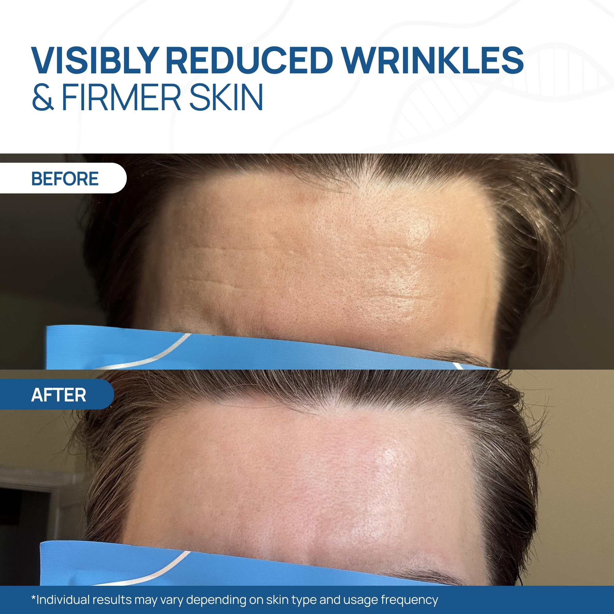 Welaroise Bio Protein - Mascarilla facial profunda de hidrogel de colágeno + 35% más de colágeno, hidratación intensa e hidratación, reafirmante, antienvejecimiento, renovación de la piel, cuidado de