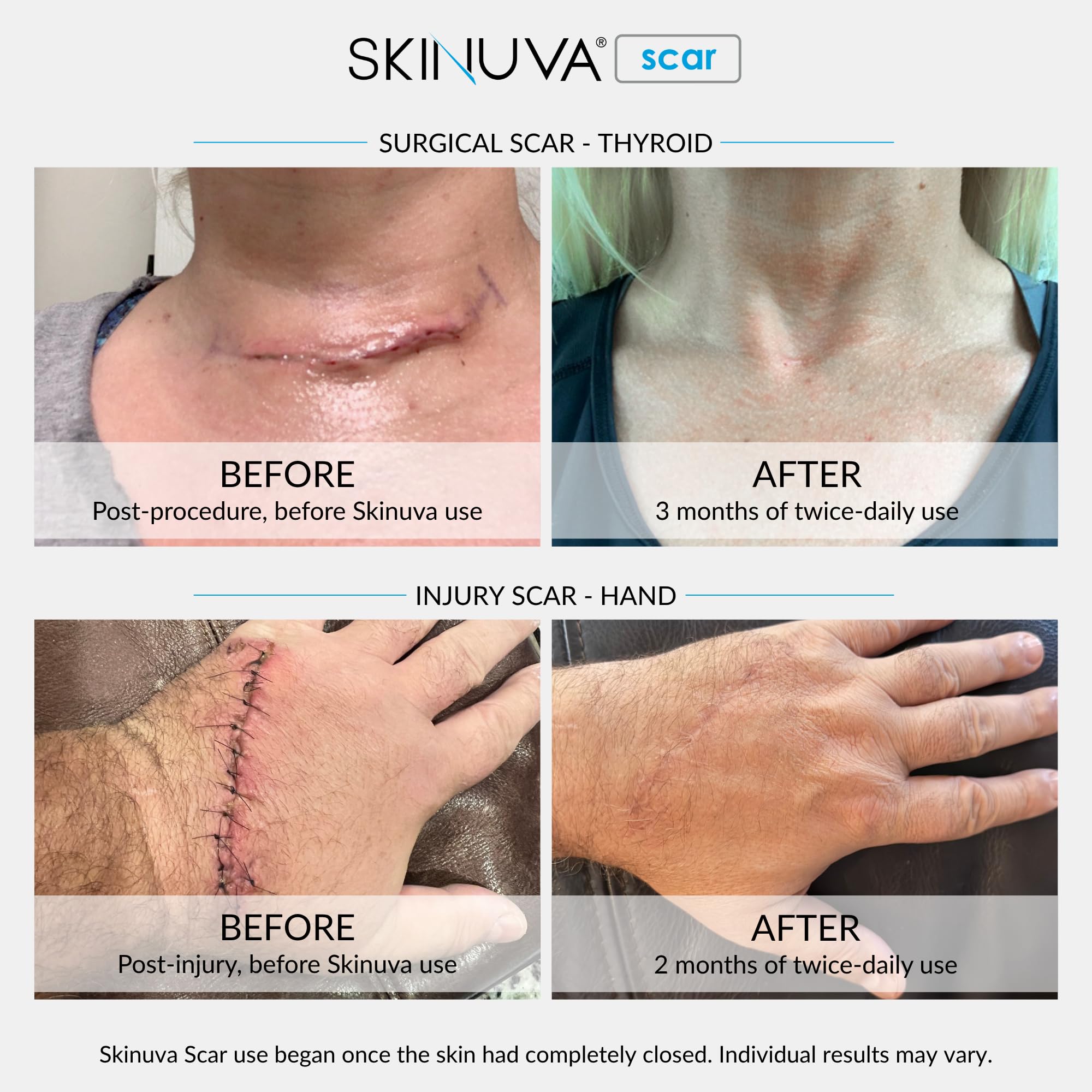 Skinuva® Scar Cream for Face & Body (1.7 oz) — Amazon image 3