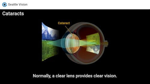 Eye GIFs - Ophthalmic & Eye Care Patient Education