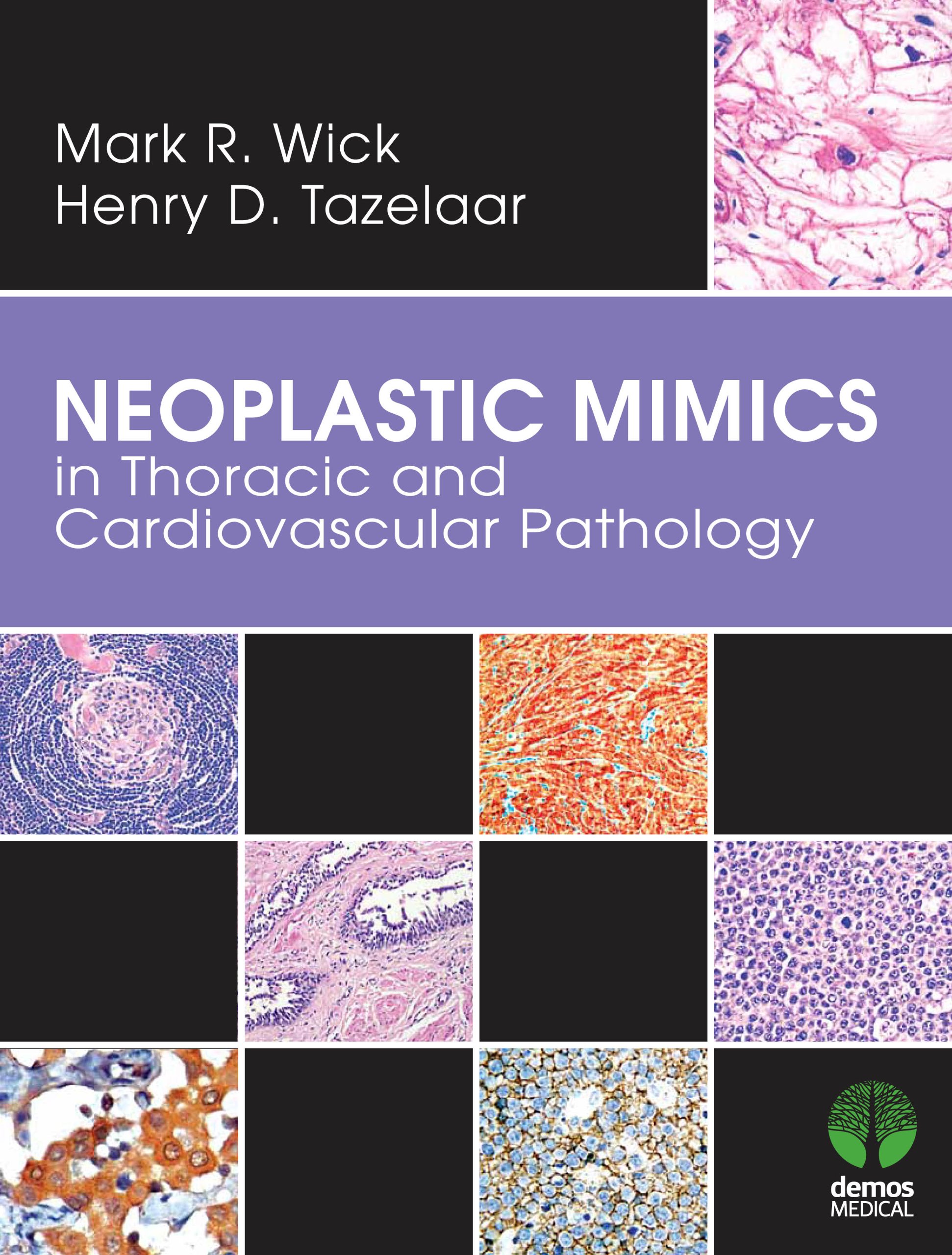 Neoplastic Mimics in Thoracic and Cardiovascular Pathology (Pathology of Neoplastic Mimics)