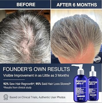Hair Growth Serum for Men & Women | DHT Blocker for Hair Loss & Regrowth | Thickening Thinning Hair | 4% AnaGainTM, Biotin & Caffeine | Dermatologist Recommended | Minoxidil Compatible | Guyology Labs