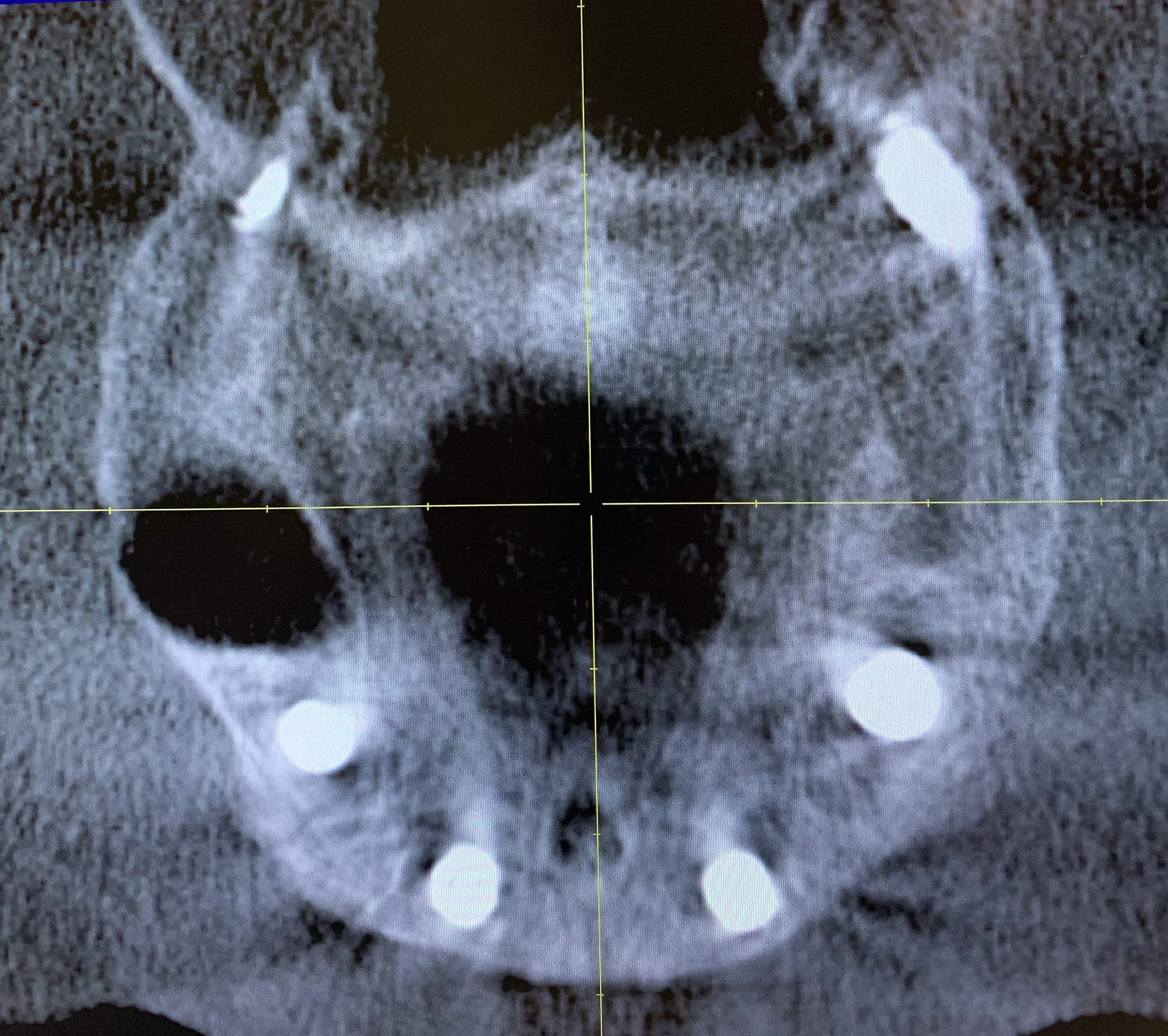 Pterygoid Implants: The Art and Science product thumbnail 5