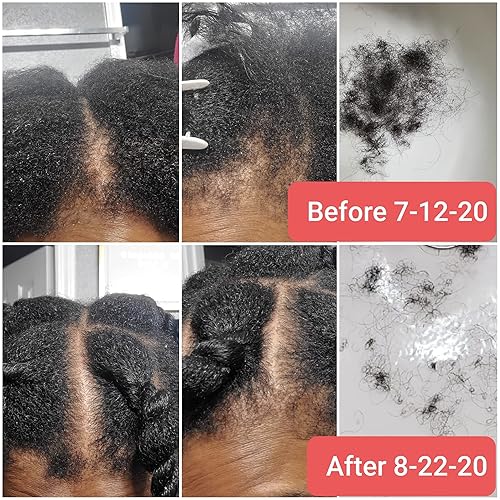 Miniatura 3 de CWHaircare Spray para el cuero cabelludo (el arma secreta) para ayudar a revertir la alopecia y la pérdida general de cabello al promover tasas de