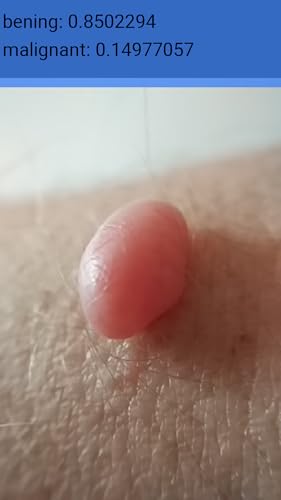 MoleScreener - Melanoma Skin Cancer Screening Tool