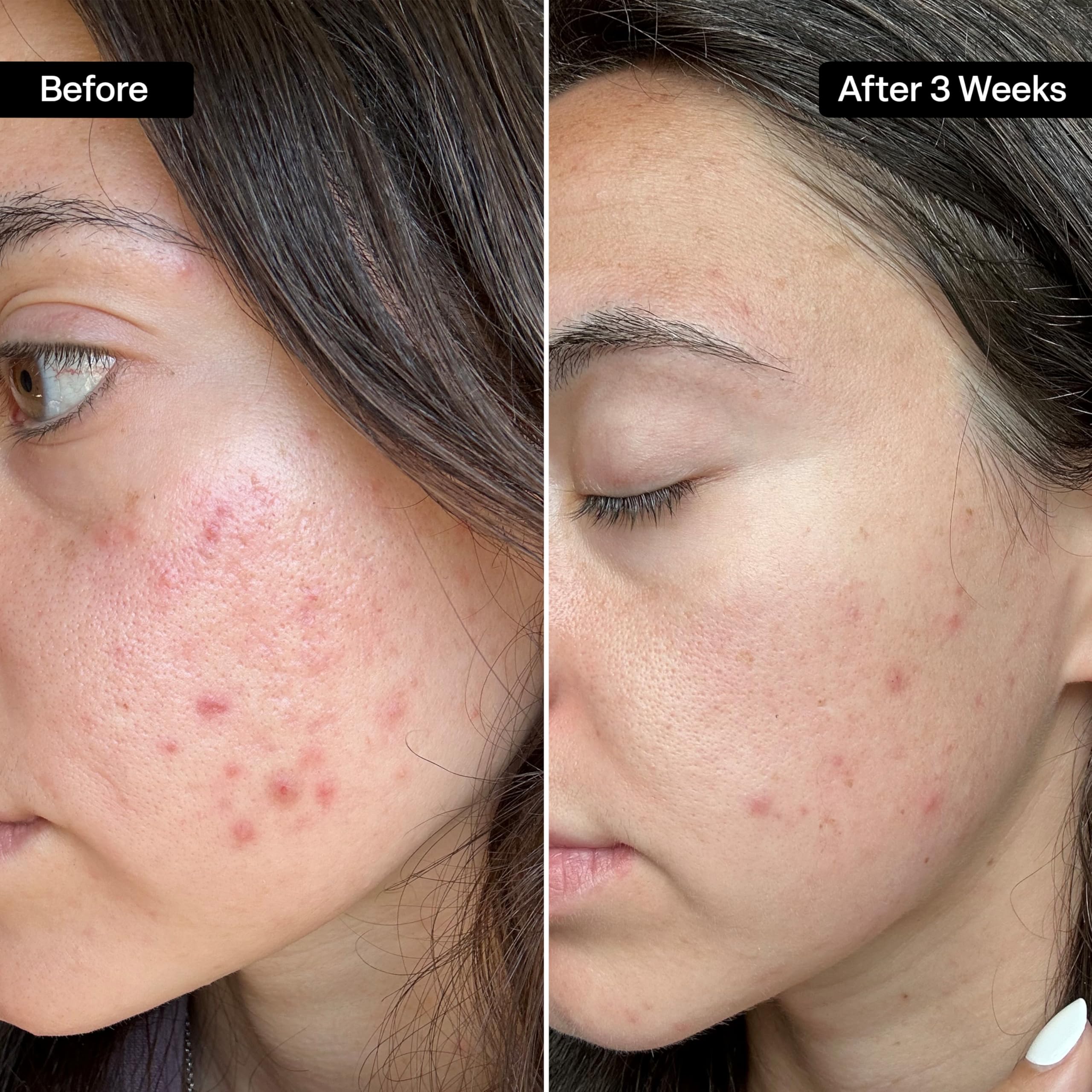 Glycolic/Salicylic Acid 10/2 Acne Control Pads with 10% Ultra Pure Glycolic Acid + 2% Salicylic Acid, Allantoin, Vitamins B5, C & E, Calendula & Green Tea - Most Effective Acne Treatment - Clear Skin
