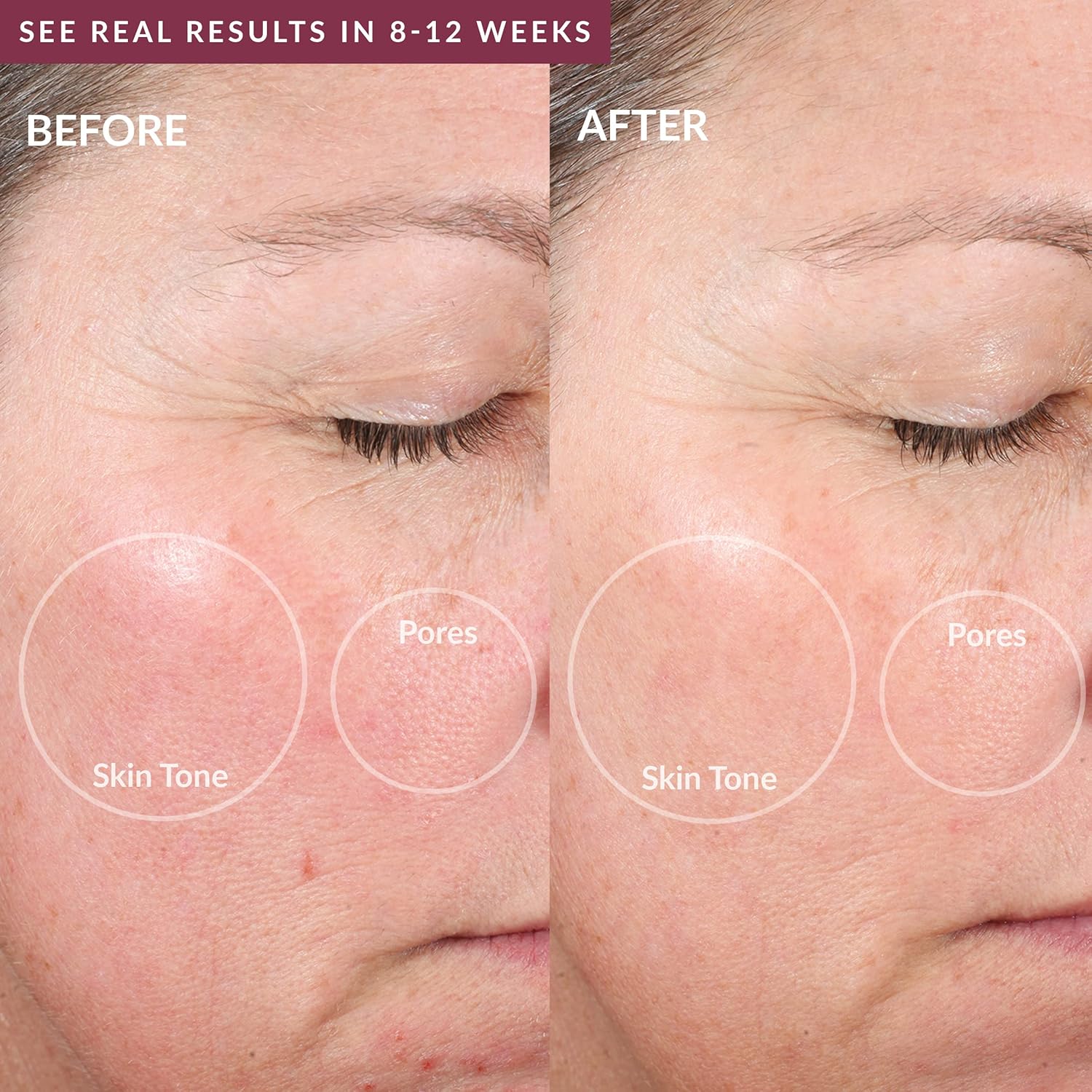 PMD Personal Microderm Elite Pro AtHome Microdermabrasion Machine with Kit for Face and Body