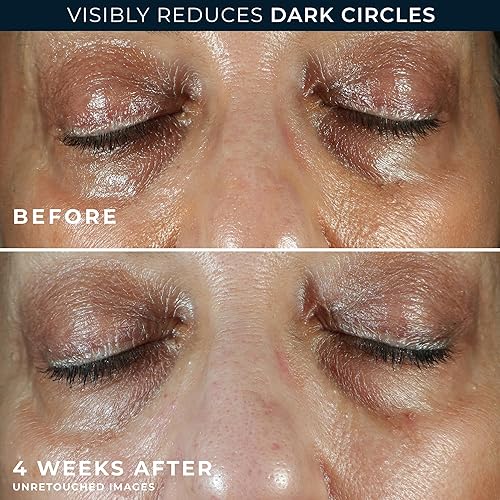 Miniatura 5 de RoC Multi Correxion 5 en 1 Crema de ojos antienvejecimiento para hinchazón, bolsas debajo de los ojos y ojeras, tratamiento de cuidado de la piel